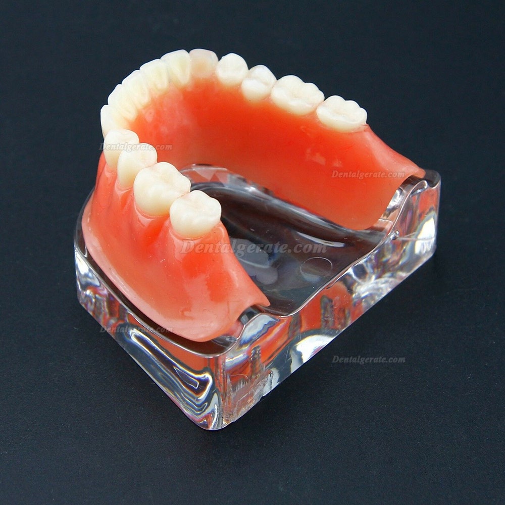 Dental Overdenture Typodont Modell Minderwertiges Pr&auml;zisionsimplantat Golden 6009
